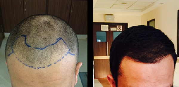 4 Mistakes You Should Avoid for a Successful Hair Transplant