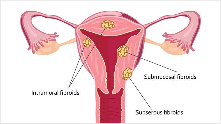 An Expert Guide to Understanding Uterine Fibroids