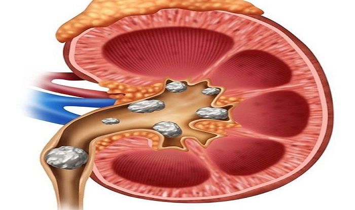 How to Use Sound Waves to Break Up Kidney Stones.