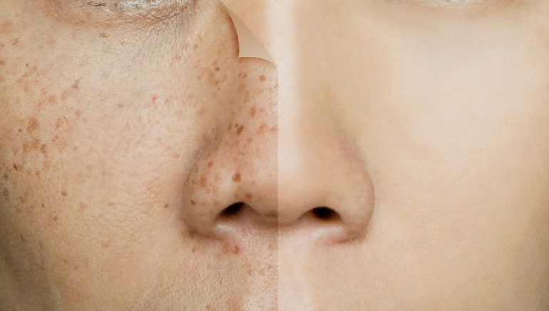 Dealing with Facial Pigmentation Causes and Effective Treatments