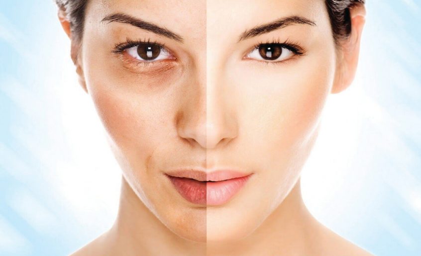 Combatting Skin Discoloration with a Proven Melasma Treatment